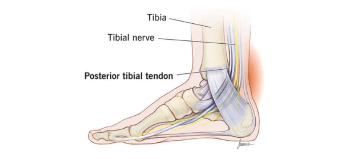 Posterior Tibial Tendon Dysfunction